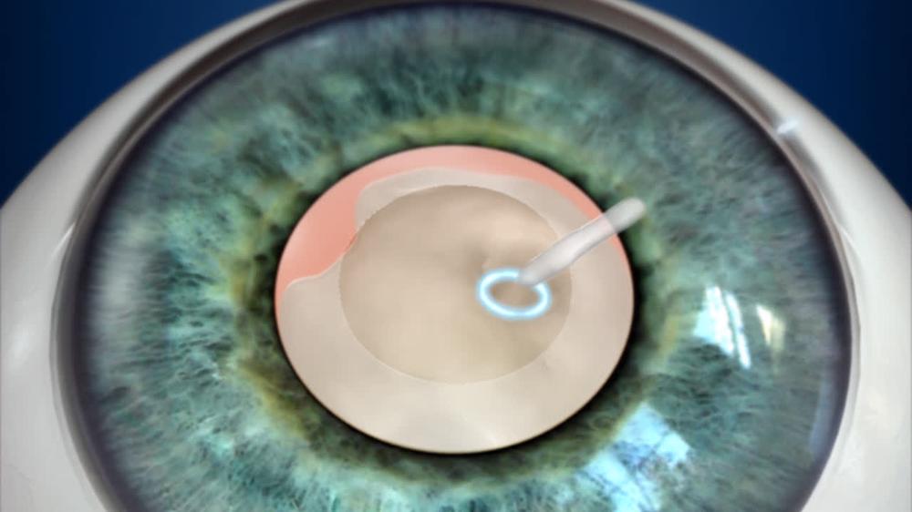 Cataract Surgery: Traditional (No Tools)