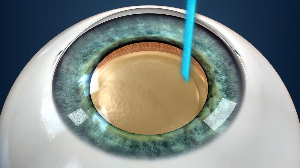 Cataract Surgery: Laser