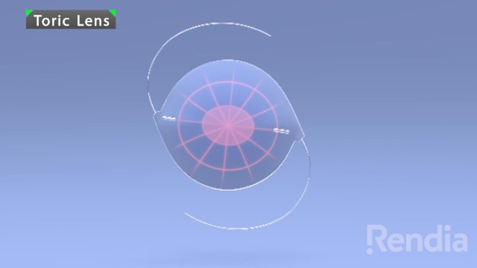 IOL: Toric Lens - Overview