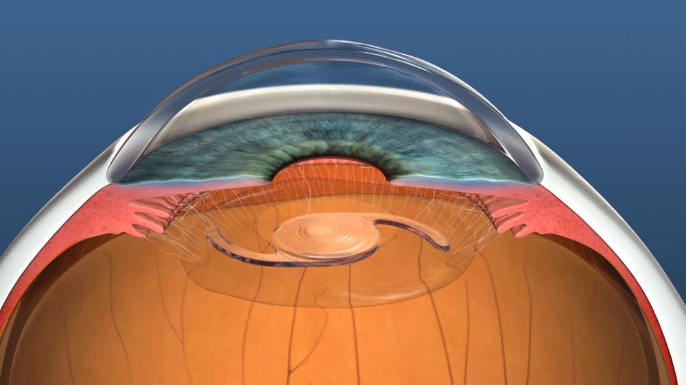 IOL: Refractive Lens Exchange - Overview