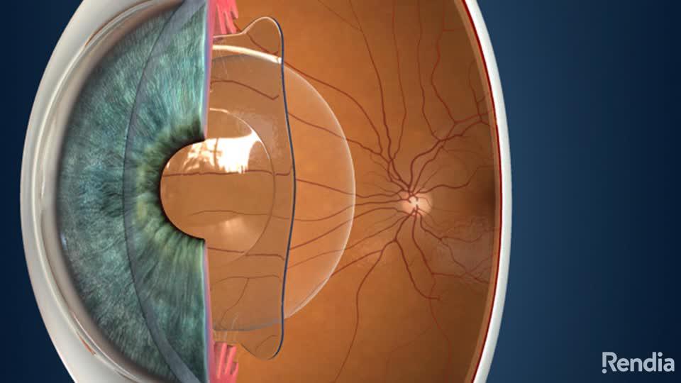 ICL: Overview - Posterior