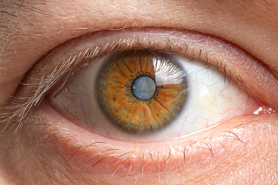 Cataract Diagram