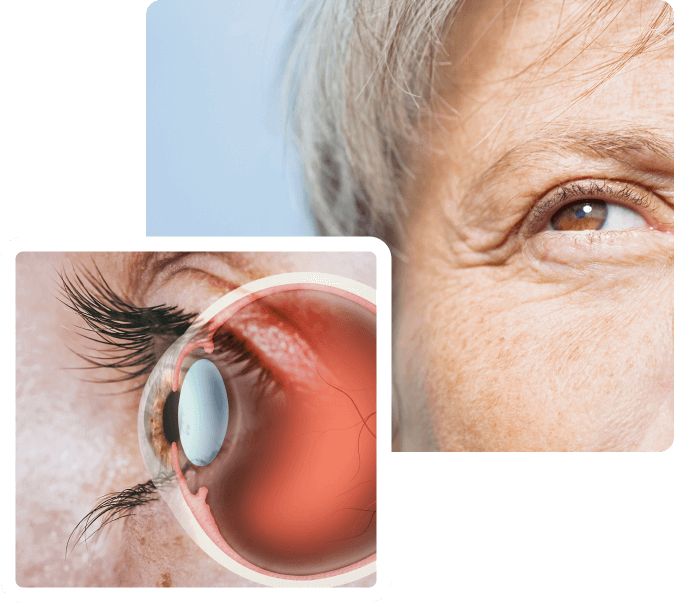 Cataract Technique